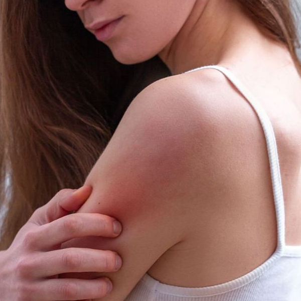 Woman with a rash in her arm